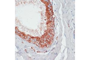 Immunohistochemistry of paraffin-embedded human mammary cancer using PGK2 antibody (ABIN6128431, ABIN6145506, ABIN6145507 and ABIN6216775) at dilution of 1:100 (40x lens). (PGK2 antibody  (AA 242-360))