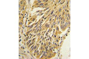 Formalin-fixed and paraffin-embedded human lung carcinoma with IL1B Antibody (Center), which was peroxidase-conjugated to the secondary antibody, followed by DAB staining. (IL-1 beta antibody  (AA 148-174))