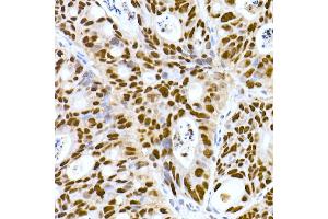 Immunohistochemistry of paraffin-embedded human colon carcinoma using DNA-PKcs Rabbit mAb (ABIN7269665) at dilution of 1:100 (40x lens).