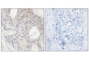 Immunohistochemistry analysis of paraffin-embedded human breast carcinoma tissue, using Cytochrome P450 1A2 antibody. (CYP1A2 antibody  (Internal Region))