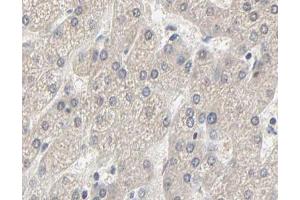 ABIN6267630 at 1/200 staining human liver cancer tissue sections by IHC-P. (Acetyl-CoA Carboxylase alpha antibody  (pSer79))