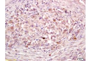 Formalin-fixed and paraffin embedded human lung carcinoma labeled with Anti-P2X2/ATP receptor Polyclonal Antibody, Unconjugated  at 1:200 followed by conjugation to the secondary antibody and DAB staining. (P2RX6 antibody  (AA 251-350))