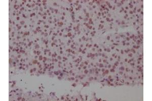 IHC image of ABIN7127813 diluted at 1:100 and staining in paraffin-embedded human glioma cancer performed on a Leica BondTM system. (Recombinant SMC1A antibody)