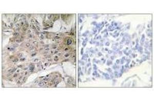 Immunohistochemistry analysis of paraffin-embedded human breast carcinoma tissue using COX7S/A2 antibody. (COX7A2P2 antibody)