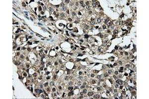 Immunohistochemical staining of paraffin-embedded Adenocarcinoma of breast tissue using anti-PLEK mouse monoclonal antibody.