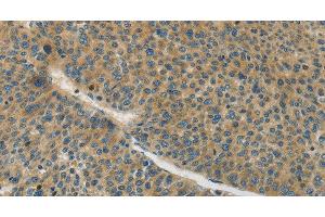Immunohistochemistry of paraffin-embedded Human liver cancer tissue using Connexin-45 Polyclonal Antibody at dilution 1:50 (GJC1 antibody)
