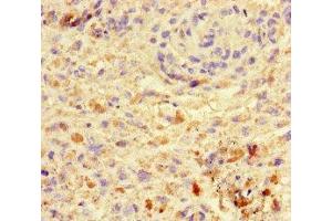 Immunohistochemistry of paraffin-embedded human melanoma using ABIN7172419 at dilution of 1:100 (VGLL4 antibody  (AA 43-277))