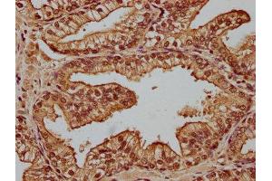 IHC image of ABIN7148511 diluted at 1:100 and staining in paraffin-embedded human prostate cancer performed on a Leica BondTM system. (CPNE1 antibody  (AA 326-537))