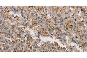 Immunohistochemistry of paraffin-embedded Human liver cancer tissue using KIF17 Polyclonal Antibody at dilution 1:40 (KIF17 antibody)