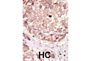 Formalin-fixed and paraffin-embedded human hepatocellular carcinoma tissue reacted with HIPK3 polyclonal antibody  , which was peroxidase-conjugated to the secondary antibody, followed by DAB staining.