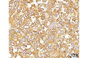 IHC staining of human melanoma (20X) with gp100 antibody (HMB45). (Melanoma gp100 antibody)