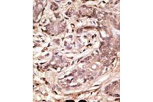 Formalin-fixed and paraffin-embedded human cancer tissue reacted with the primary antibody, which was peroxidase-conjugated to the secondary antibody, followed by AEC staining. (SUMO4 antibody  (AA 34-63))