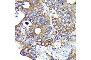 Immunohistochemistry of paraffin-embedded human colon carcinoma using Ezrin Rabbit mAb (ABIN7267077) at dilution of 1:100 (40x lens). (Ezrin antibody)