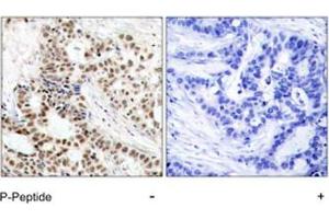 Immunohistochemical analysis of paraffin-embedded human breast carcinoma tissue using BRCA1 (phospho S1423) polyclonal antibody . (BRCA1 antibody  (pSer1423))