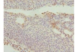 Immunohistochemistry of paraffin-embedded human bladder cancer using ABIN7150145 at dilution of 1:100 (DRAM2 antibody  (AA 182-266))
