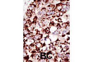 Formalin-fixed and paraffin-embedded human cancer tissue reacted with PIGK polyclonal antibody  , which was peroxidase-conjugated to the secondary antibody, followed by DAB staining . (PIGK antibody  (C-Term))