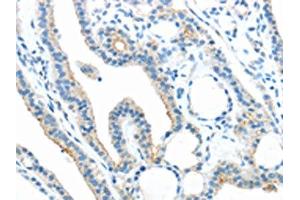 The image on the left is immunohistochemistry of paraffin-embedded Human thyroid cancer tissue using ABIN7189804(ANGPTL5 Antibody) at dilution 1/25, on the right is treated with synthetic peptide. (ANGPTL5 antibody)