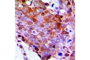 Immunohistochemical analysis of RPL13 staining in human breast cancer formalin fixed paraffin embedded tissue section. (RPL13 antibody)