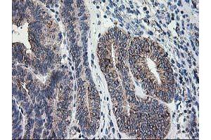 Immunohistochemical staining of paraffin-embedded Adenocarcinoma of Human endometrium tissue using anti-DLD mouse monoclonal antibody. (DLD antibody)