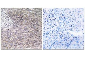Immunohistochemistry analysis of paraffin-embedded human cervix carcinoma tissue using CHSS2 antibody. (CHPF antibody  (C-Term))