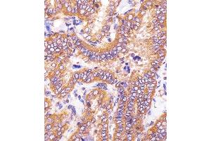(ABIN6243230 and ABIN6578764) staining HSD17B10 in human thyroid carcinoma sections by Immunohistochemistry (IHC-P - paraformaldehyde-fixed, paraffin-embedded sections). (HSD17B10 antibody  (AA 140-172))