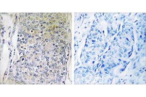 Peptide - +Immunohistochemistry analysis of paraffin-embedded human breast carcinoma tissue using CPXM2 antibody.