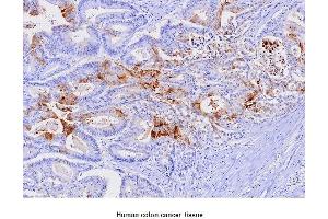 Paraffin embedded sections of human colon canitrocelluloseer tissue were initrocelluloseubated with anti-human FABP1 (1:100) for 2 hours at room temperature. (FABP1 antibody  (AA 1-127))