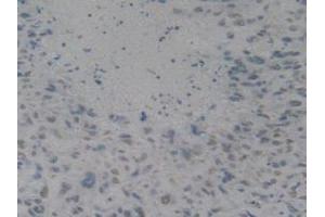 IHC-P analysis of Human Lung Cancer Tissue, with DAB staining. (HMGB1 antibody  (AA 9-163))