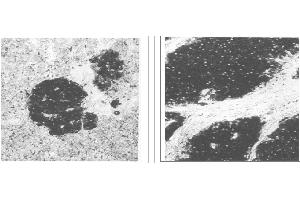Immunohistochemical staining of normal pancreas tissue (left) and small bowel tumor tissue (center) using NSE antibody (X2070M and X2071M). (Enolase antibody)