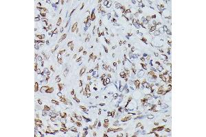 Immunohistochemistry of paraffin-embedded human oophoroma using Lamin B1 antibody (ABIN1513160, ABIN3023296 and ABIN3023297) at dilution of 1:100 (40x lens). (Lamin B1 antibody)