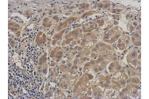 IHC-P Image Immunohistochemical analysis of paraffin-embedded human hepatoma, using ALS, antibody at 1:500 dilution. (IGFALS antibody  (C-Term))