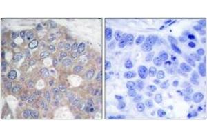 Immunohistochemistry analysis of paraffin-embedded human breast carcinoma tissue, using p70 S6 Kinase (Ab-421) Antibody. (RPS6KB1 antibody  (AA 411-460))