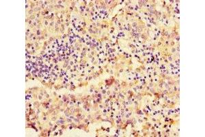 Immunohistochemistry of paraffin-embedded human lung cancer using ABIN7161043 at dilution of 1:100 (NAPSA antibody  (AA 64-420))