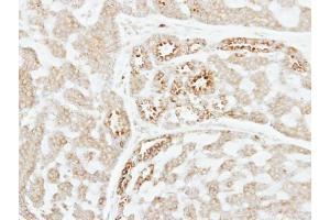 IHC-P Image Immunohistochemical analysis of paraffin-embedded human breast cancer, using Factor XI, antibody at 1:250 dilution. (Factor XI antibody)