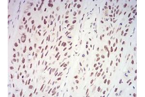 Immunohistochemical analysis of paraffin-embedded esophageal cancer tissues using XRN2 mouse mAb with DAB staining.