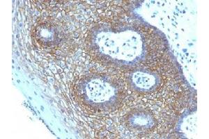 IHC testing of FFPE human cervical squamos cell carcinoma with CD44v4 antibody (clone CD44v4/1219).