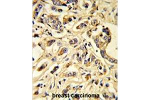 Formalin-fixed and paraffin-embedded human breast carcinoma reacted with VGFR1 Antibody, which was peroxidase-conjugated to the secondary antibody, followed by DAB staining. (FLT1 antibody)