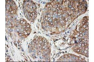 Immunohistochemical staining of paraffin-embedded Adenocarcinoma of Human breast tissue using anti-TUBB4 mouse monoclonal antibody.