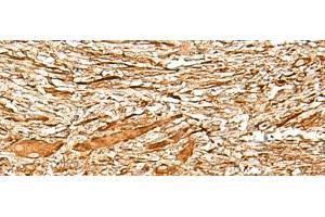 Immunohistochemistry of paraffin-embedded Human liver cancer tissue using ADGRF1 Polyclonal Antibody at dilution of 1:35(x200) (G Protein-Coupled Receptor 110 antibody)