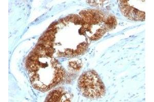 IHC staining of human prostate carcinoma with TAG-72 antibody cocktail (B72. (TAG-72 antibody)