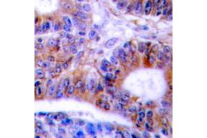Immunohistochemical analysis of Cytokeratin 20 staining in human colon cancer formalin fixed paraffin embedded tissue section. (KRT20 antibody  (C-Term))