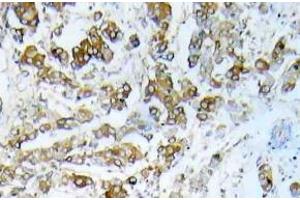 Immunohistochemistry (IHC) analyzes of HSP27 pAb in paraffin-embedded human breast carcinoma tissue. (HSP27 antibody)