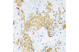 Immunohistochemistry of paraffin-embedded human lung cancer using ELN antibody (ABIN6291688) at dilution of 1:100 (40x lens).