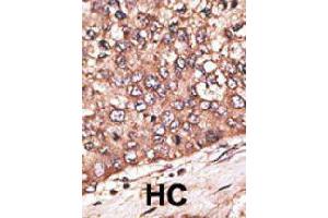 Formalin-fixed and paraffin-embedded human hepatocellular carcinoma tissue reacted with WISP1 polyclonal antibody  , which was peroxidase-conjugated to the secondary antibody, followed by DAB staining. (WISP1 antibody  (Internal Region))