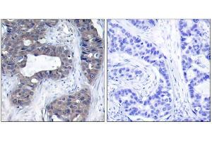 Immunohistochemical analysis of paraffin-embedded human breast carcinoma tissue, using IRS-1 (Ab-307) antibody (E021228). (IRS1 antibody)