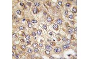 IHC analysis of FFPE human hepatocarcinoma tissue stained with Claudin 2 antibody (Claudin 2 antibody  (AA 135-164))