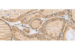 Immunohistochemistry of paraffin-embedded Human thyroid cancer tissue using MRPL40 Polyclonal Antibody at dilution of 1:80(x200) (MRPL40 antibody)