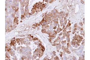 IHC-P Image Immunohistochemical analysis of paraffin-embedded OVCAR3 xenograft , using CBS, antibody at 1:500 dilution. (CBS antibody)