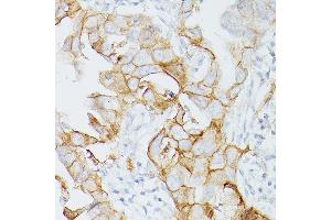 Immunohistochemistry of paraffin-embedded Human lung adenocarcinoma using PD-L1/CD274/CD274 Rabbit mAb (ABIN7266181) at dilution of 1:200 (40x lens). (PD-L1 antibody  (Extracellular Domain))