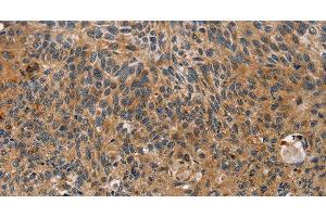 Immunohistochemistry of paraffin-embedded Human esophagus cancer tissue using TAC1 Polyclonal Antibody at dilution 1:25 (TAC1 antibody)